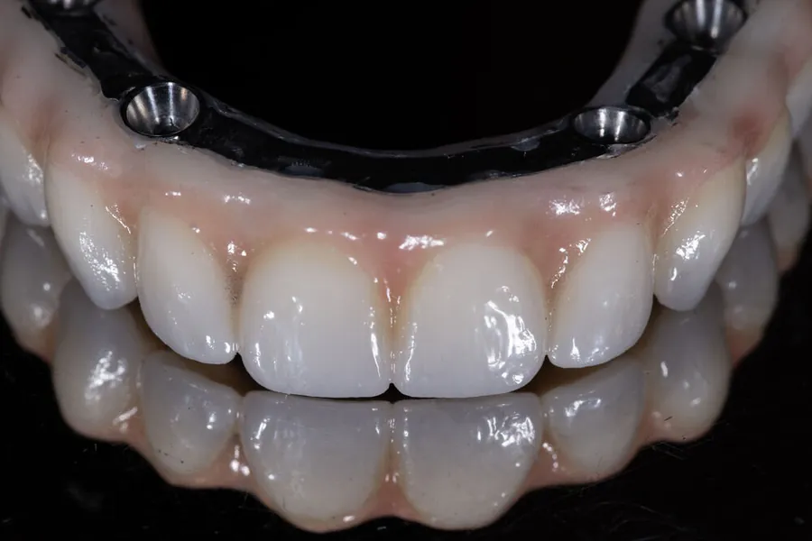 Milled zirconia full-arch bridge on titanium bar — screw-retained, made for an Epping Family Dental patient