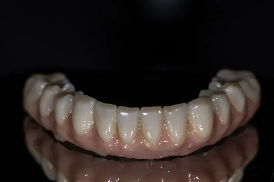 Finished lower full-arch Prettau 2 zirconia bridge