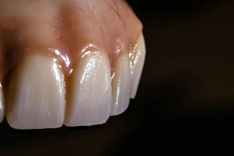 Close-up of hand-characterised zirconia front teeth and gum tinting